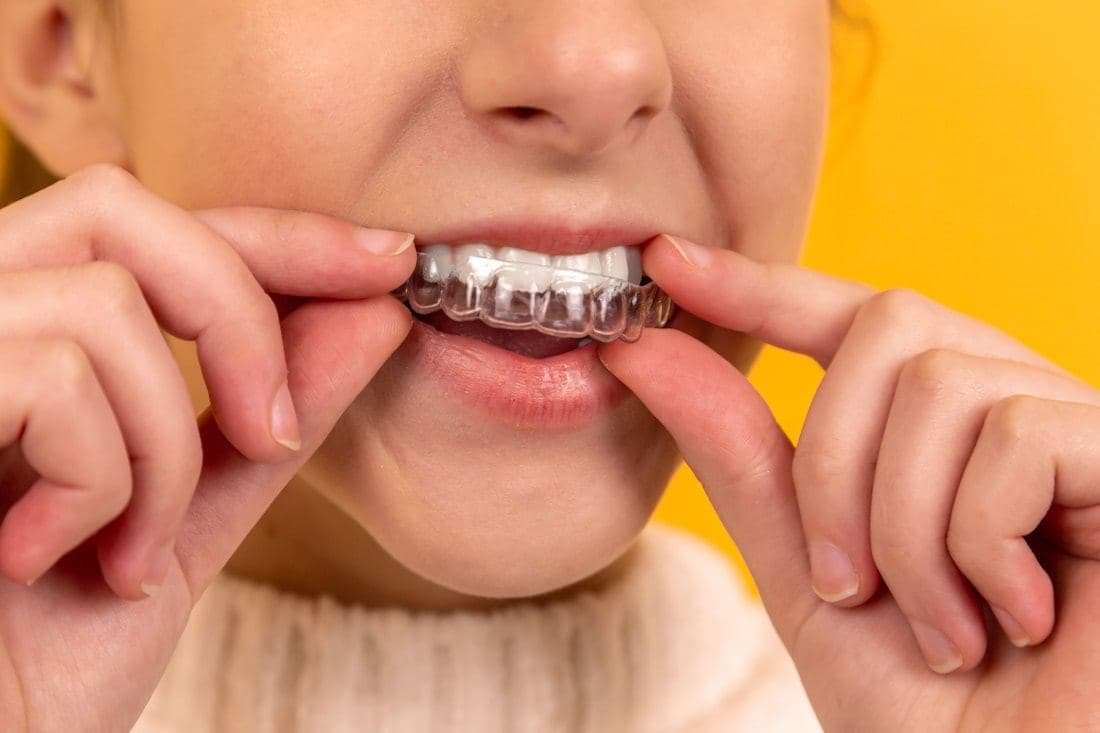 Patient fitting a clear orthodontic aligner